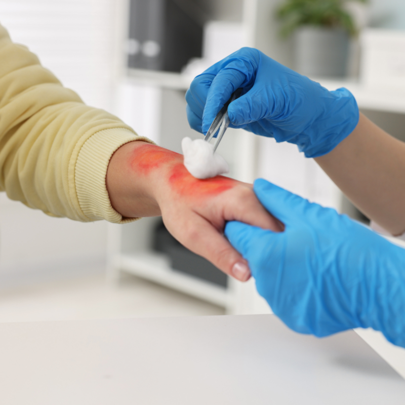 gloved hands treating burn wound